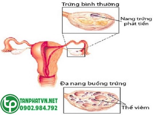Hình ảnh buồng trứng đa nang.