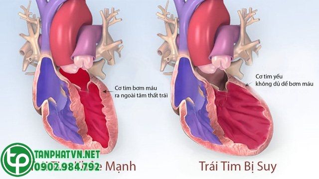 suy tim mạn tính