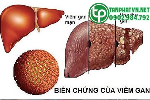 1 Biến chứng ung thư gan