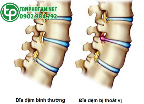 Thoát vị đĩa đệm