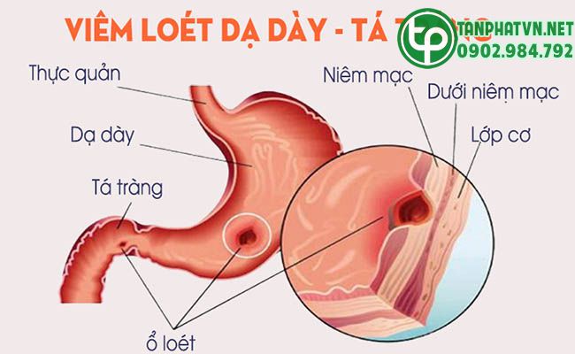 Cây dạ cẩm chữa bệnh dạ dày 2 Cây dạ cẩm chữa bệnh dạ dày?