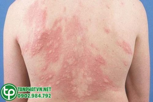 Bệnh mề đay là một loại bệnh ngoài da phổ biến