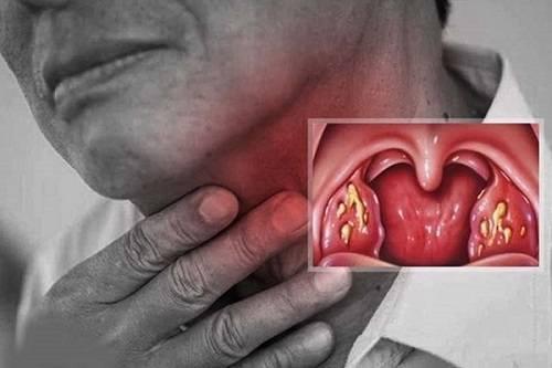 bài thuốc chữa viêm họng bài thuốc chữa viêm họng