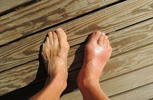 Trị bệnh gout từ tơm trơng