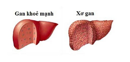 Trà túi lọc kế sữa giúp hỗ trợ điều trị bệnh gan