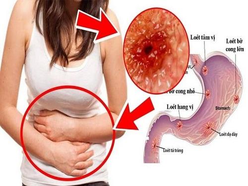Mộc hương trị viêm loét dạ dày và làm rỗng dạ dày