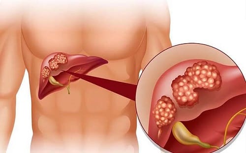 Xích đồng nam chữa viêm gan