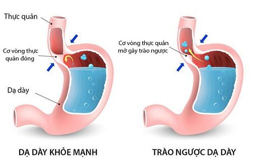 Trào ngược dạ dày là gì?