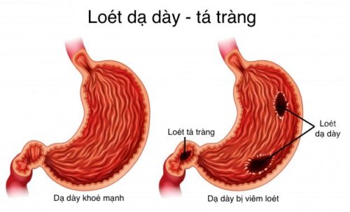 Uống trà túi lọc chè dây có giúp trị viêm loét dạ dày không ?