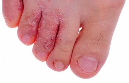 Bệnh chân vũ khí