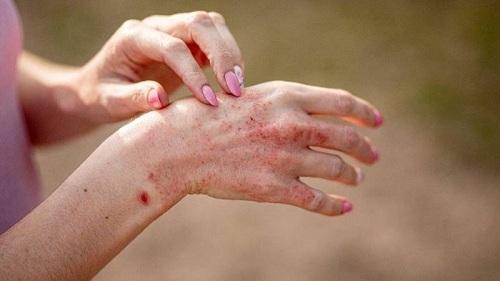 Nguyên nhân dẫn đến bệnh da liễu