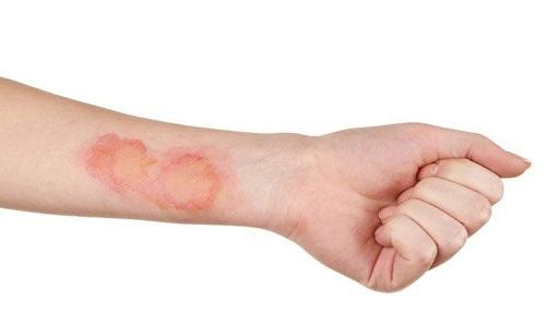 Bệnh nhiễm trùng da