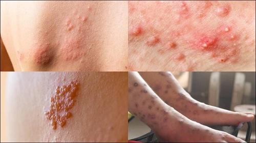Bệnh nhiễm trùng da