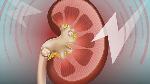 Rượu hạt chùm ngây hỗ trợ trị sỏi thận