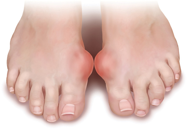 Thiên niên kiện cho người bị gút