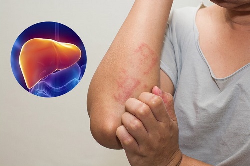 Dùng mã đề cho người bị nóng gan ?