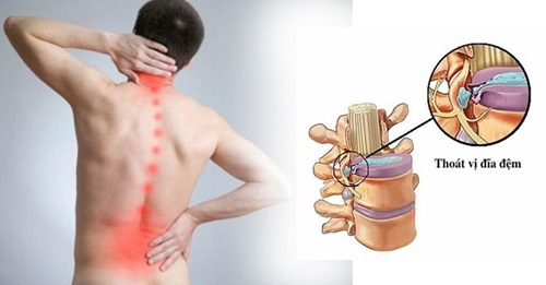 Thiên niên kiện trị thoát vị địa đệm hiệu quả
