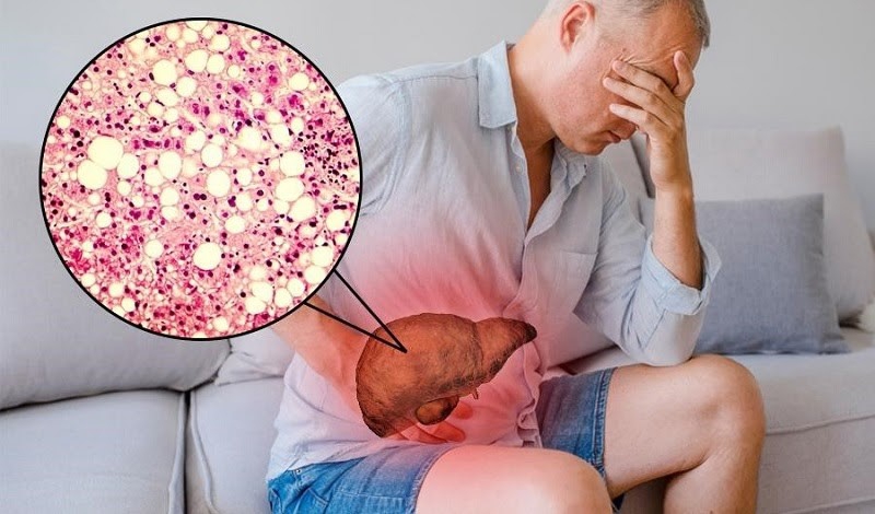Người bị gan nhiễm mỡ nên dùng trà túi lọc cà gai leo