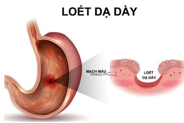 Lợi ích của trà túi lọc chè dây trị viêm loét dạ dày