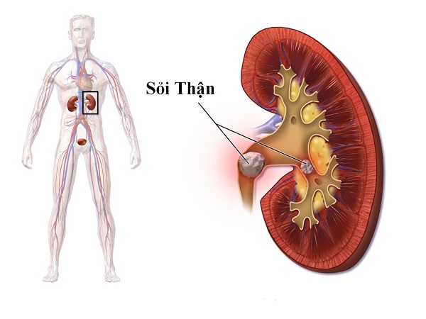 Người bị sỏi thận có nên dùng trà túi lọc cỏ mực ?