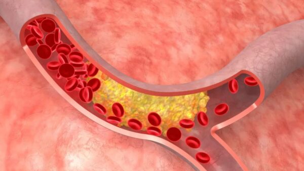 Lợi ích của trà atiso đỏ giúp giảm mỡ máu