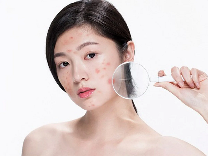 Vì sao bạn lại bị mụn ?