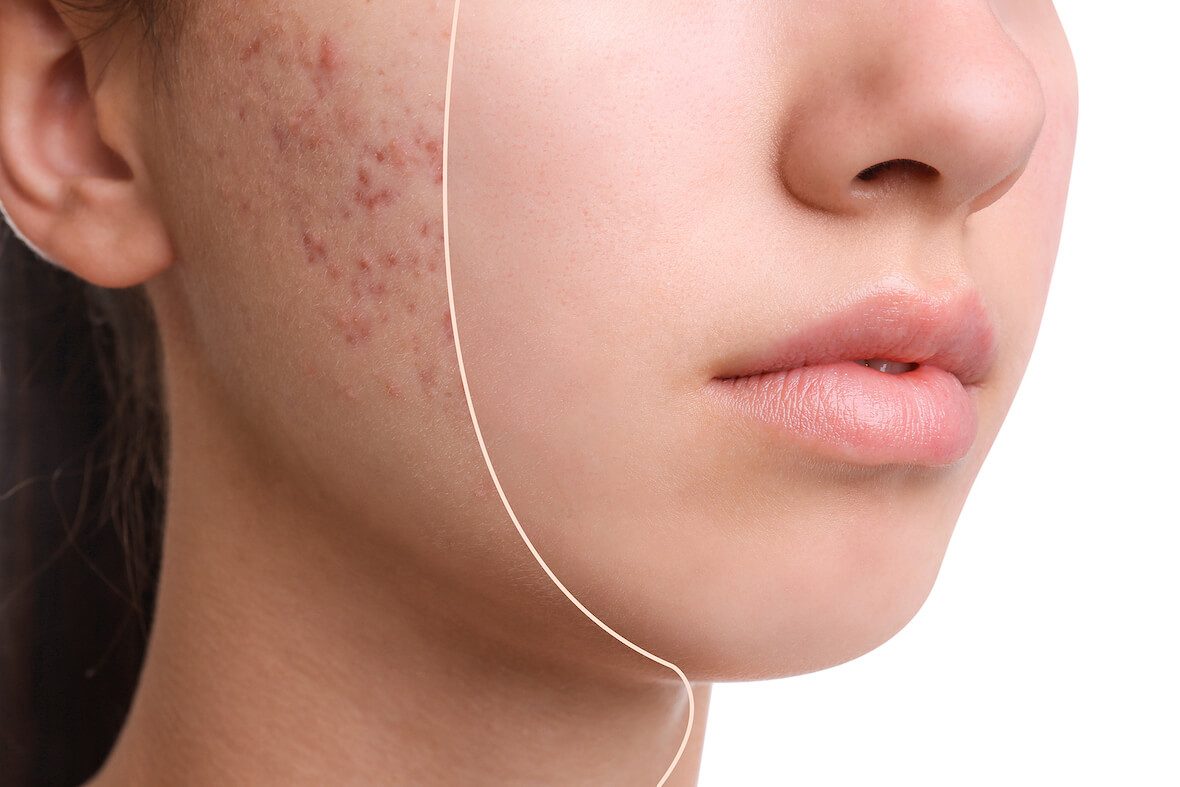 Uống trà an xoa giúp giảm mụn ?