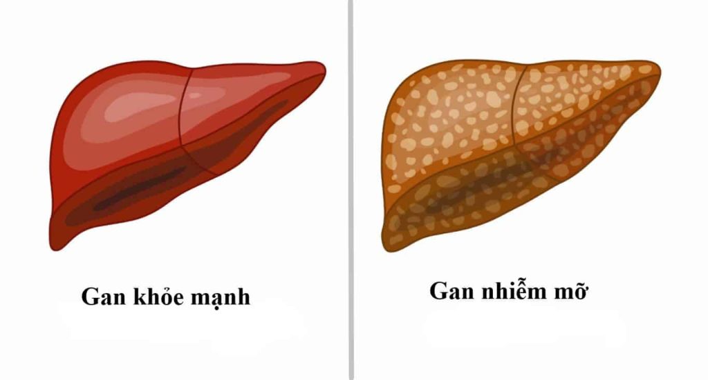 Vì sao trà túi lọc cà gai leo trị gan nhiễm mỡ hiệu quả ?