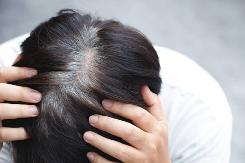 Tình trạng tóc bạc sơm là gì ?