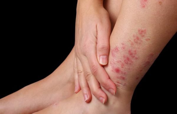 Trà túi lọc lá đơn đỏ hỗ trợ trị viêm da cơ địa ?