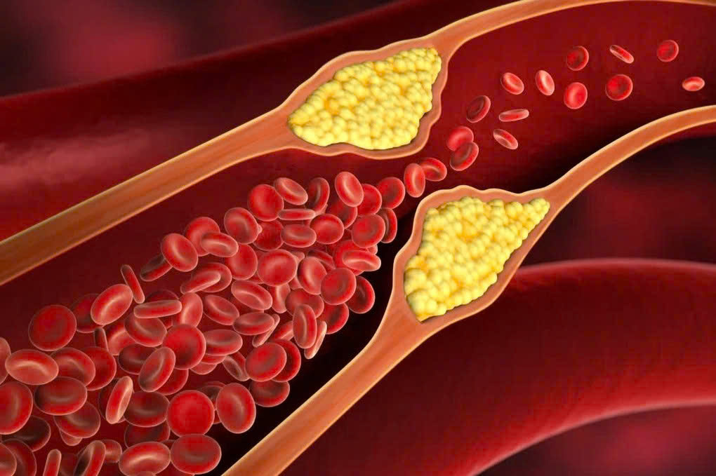 Trà lá nam giúp giảm mỡ máu không ?