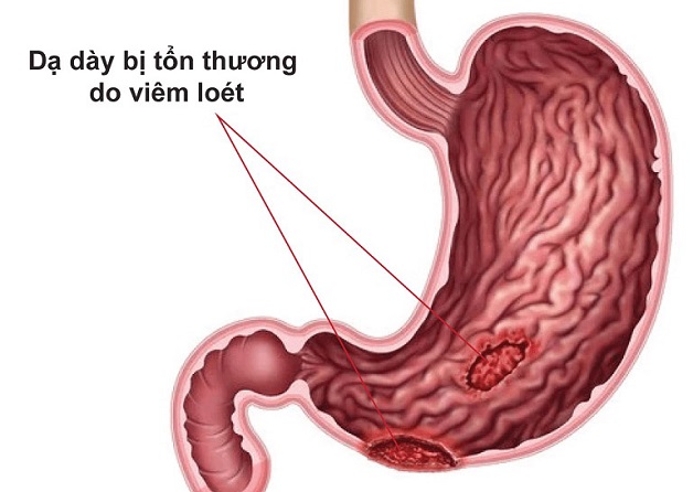 Viêm loét dạ dày là gì ?